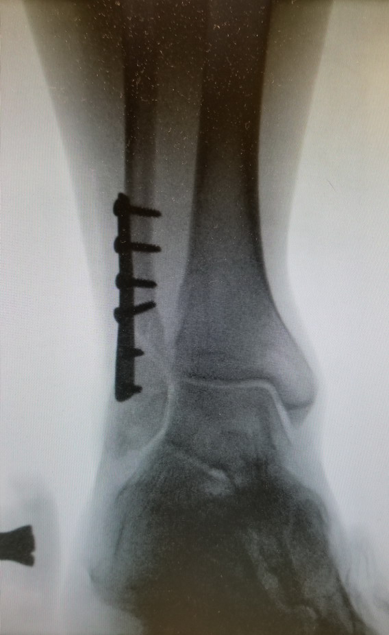 Ankle 02.jpg