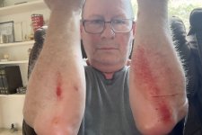 road-rash.jpg